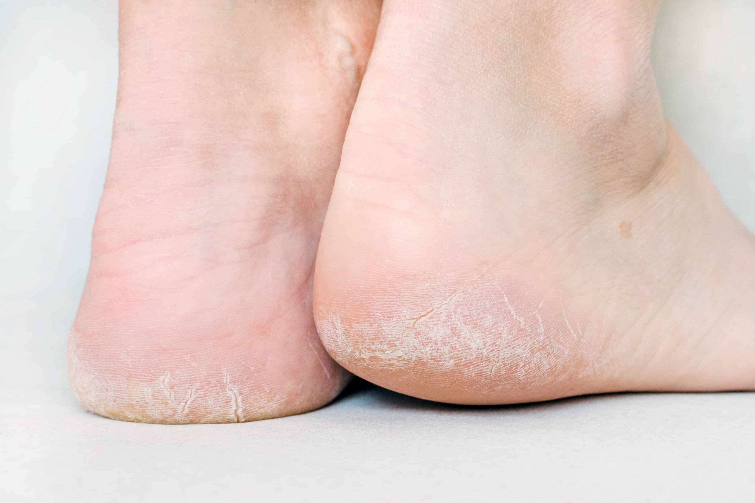 Rimedio contro calli e talloni screpolati: combatte anche i funghi