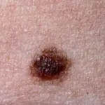 Nei o melanomi: ecco come riconoscerli