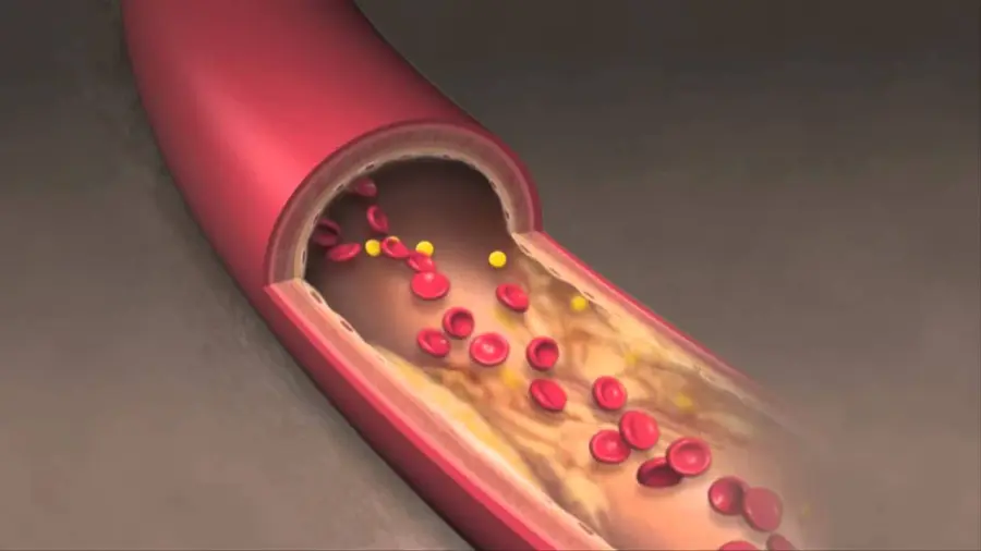 Rimedio per sbloccare le arterie: ecco gli ingredienti