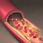 Rimedio per sbloccare le arterie: ecco gli ingredienti