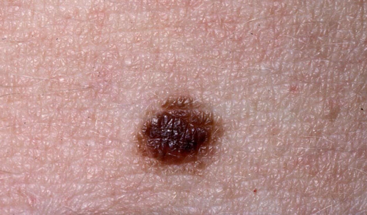 neo o melanoma riconoscimento